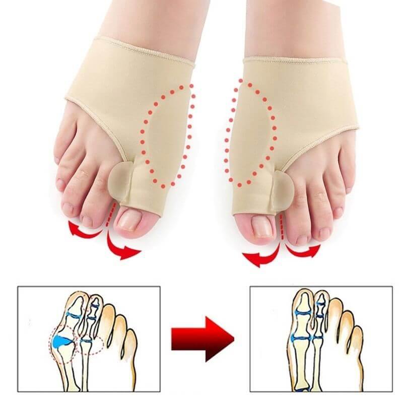 Bunion Top™ - 50%OFF🔥-Corretor  Ortopédico de Juanete (1 Par)