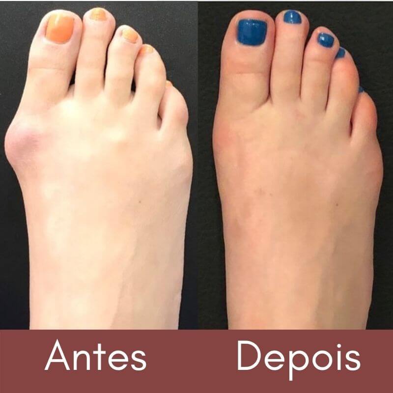 Bunion Top™ - 50%OFF🔥-Corretor  Ortopédico de Juanete (1 Par)