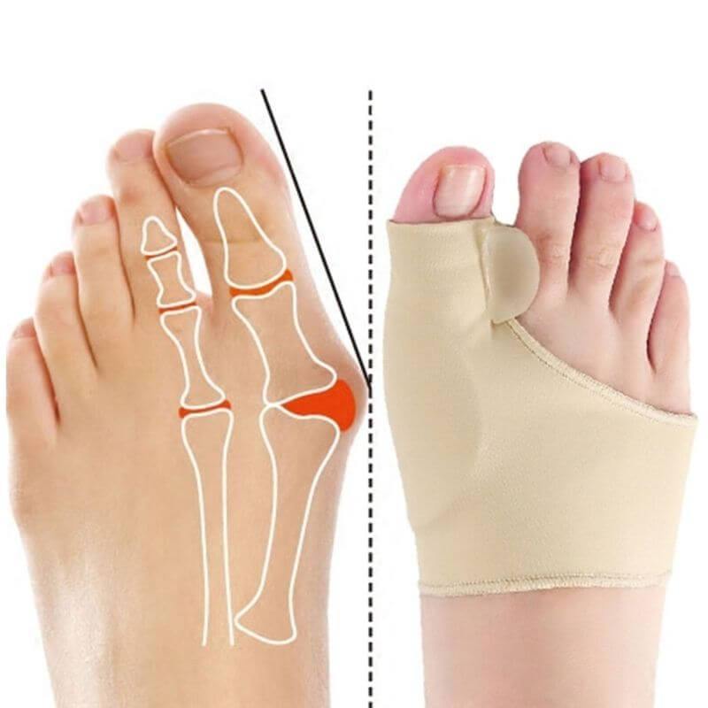 Bunion Top™ - 50%OFF🔥-Corretor  Ortopédico de Juanete (1 Par)